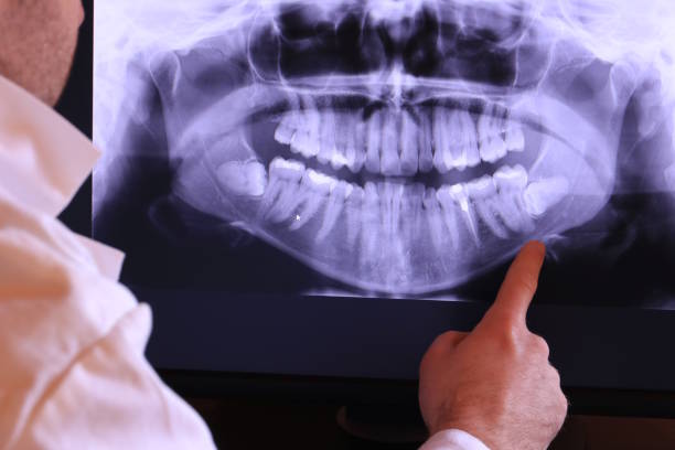 Best Emergency Dentist for Lost Fillings or Crowns in Grafton, OH